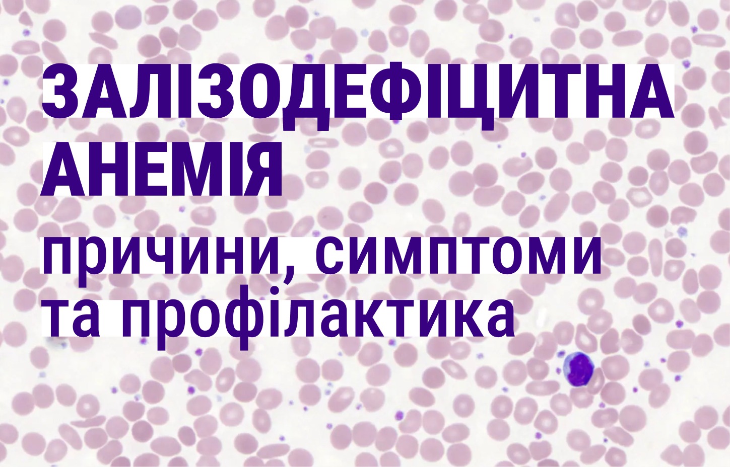 Напис: Залізодефіцитна анемія, причини, симптоми, профілактика